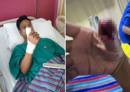 Lo Mải Mê Vuốt Điện Thoại, Nam Thanh Niên Suýt Mất Ngón Tay Cái 1 Lo Mải Mê Vuốt Điện Thoại, Nam Thanh Niên Suýt Mất Ngón Tay Cái