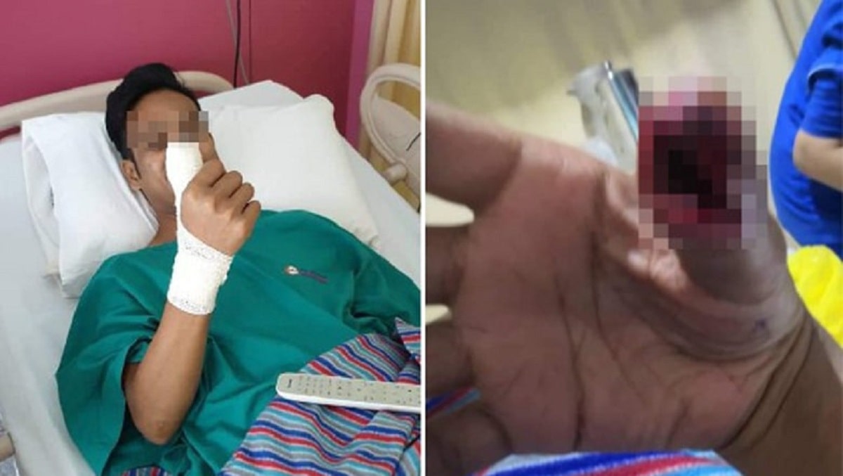 Lo Mải Mê Vuốt Điện Thoại, Nam Thanh Niên Suýt Mất Ngón Tay Cái